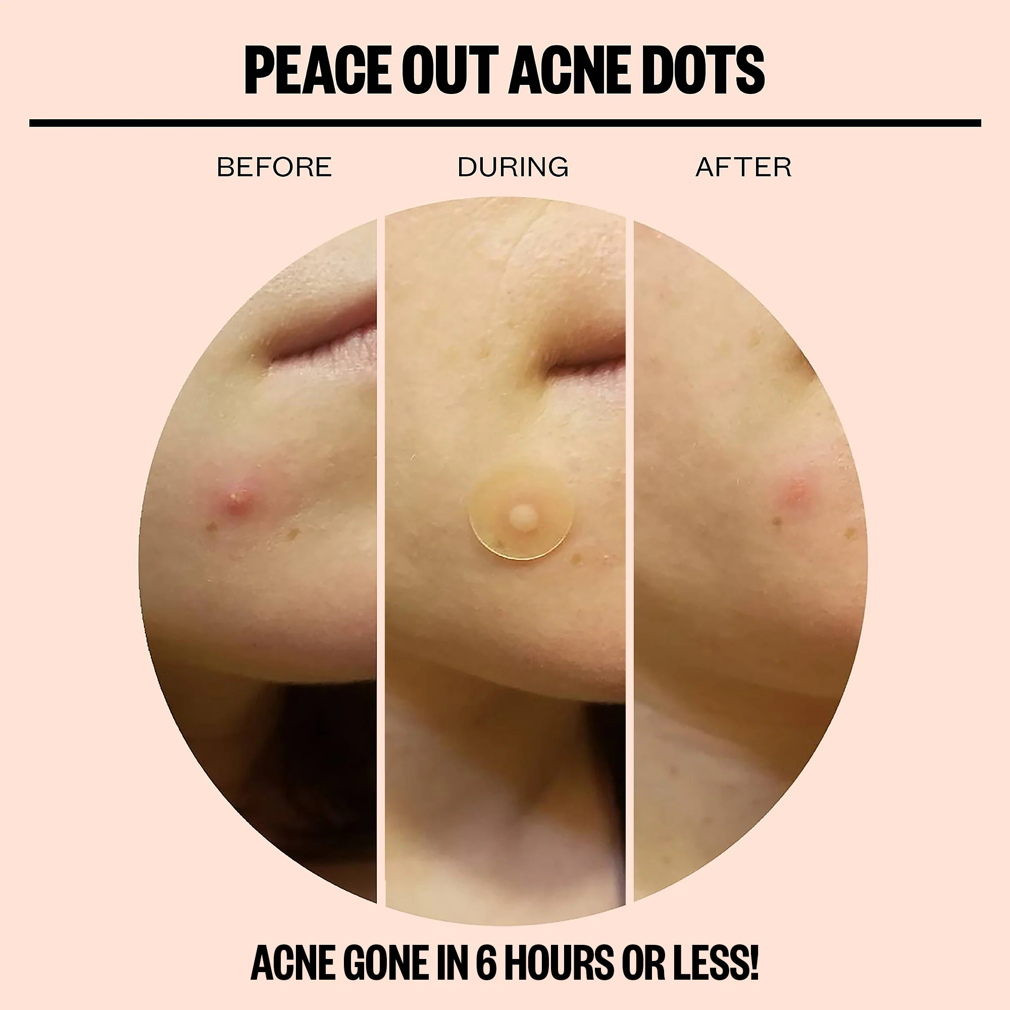 Acne Dots - 10 Pack - Image 3