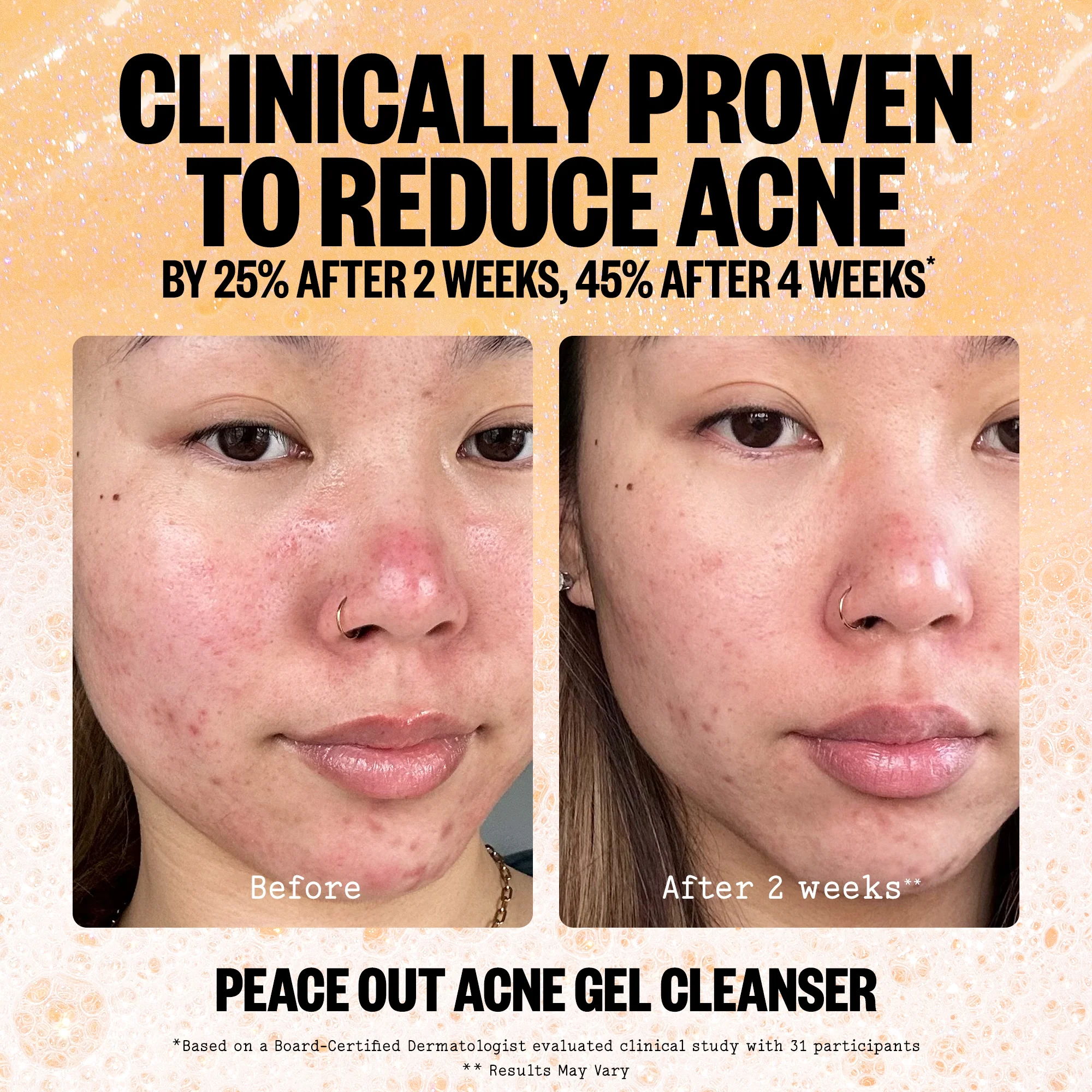 Acne Gel Cleanser - Image 6