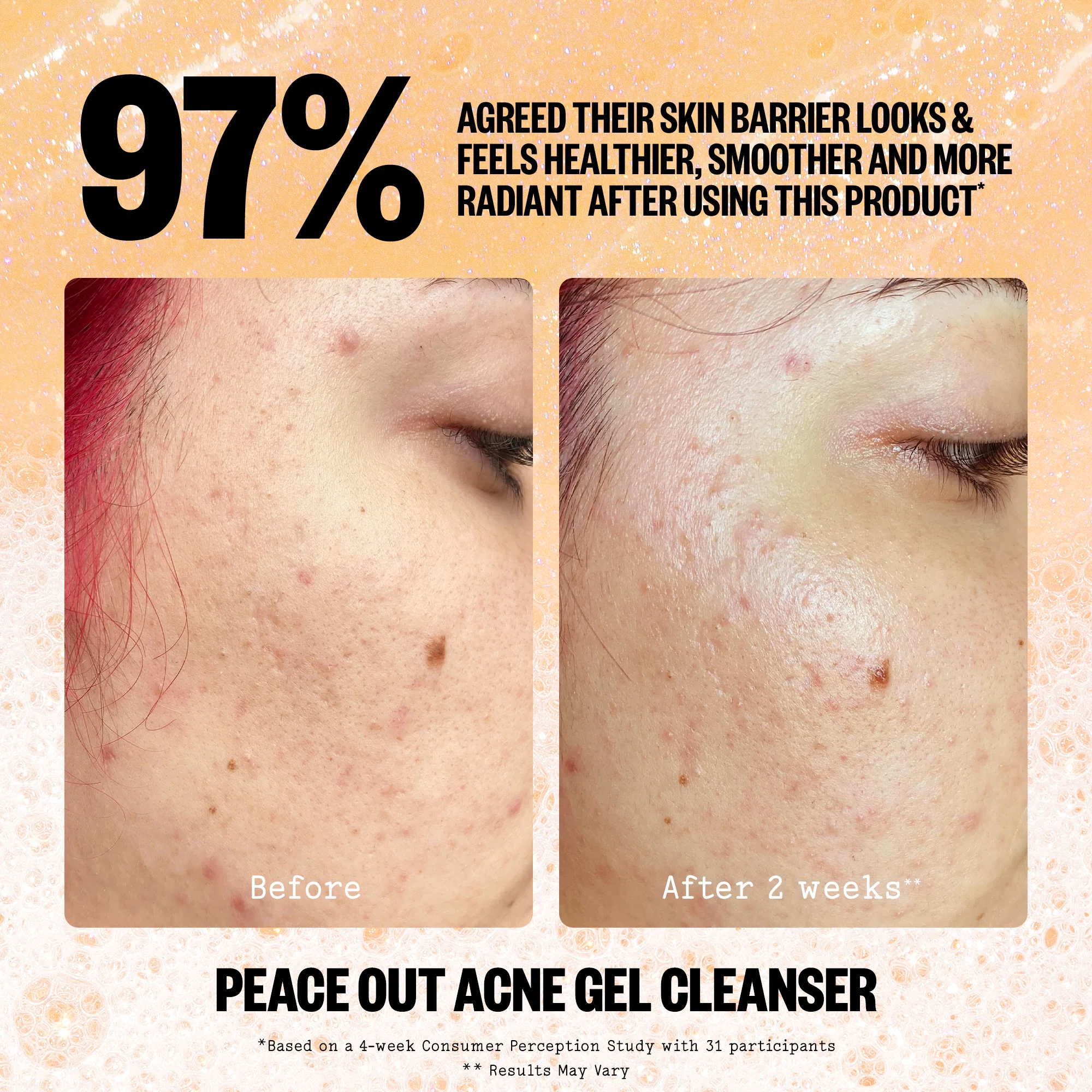 Acne Gel Cleanser - Image 9