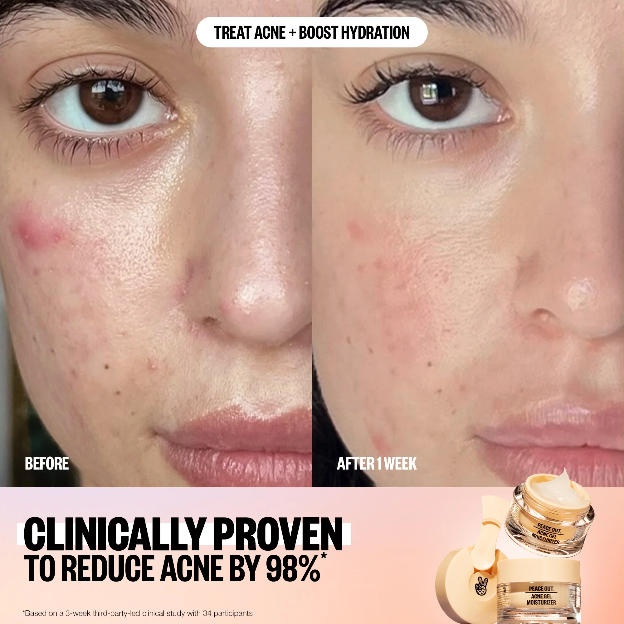 Acne Gel Moisturizer - Image 3