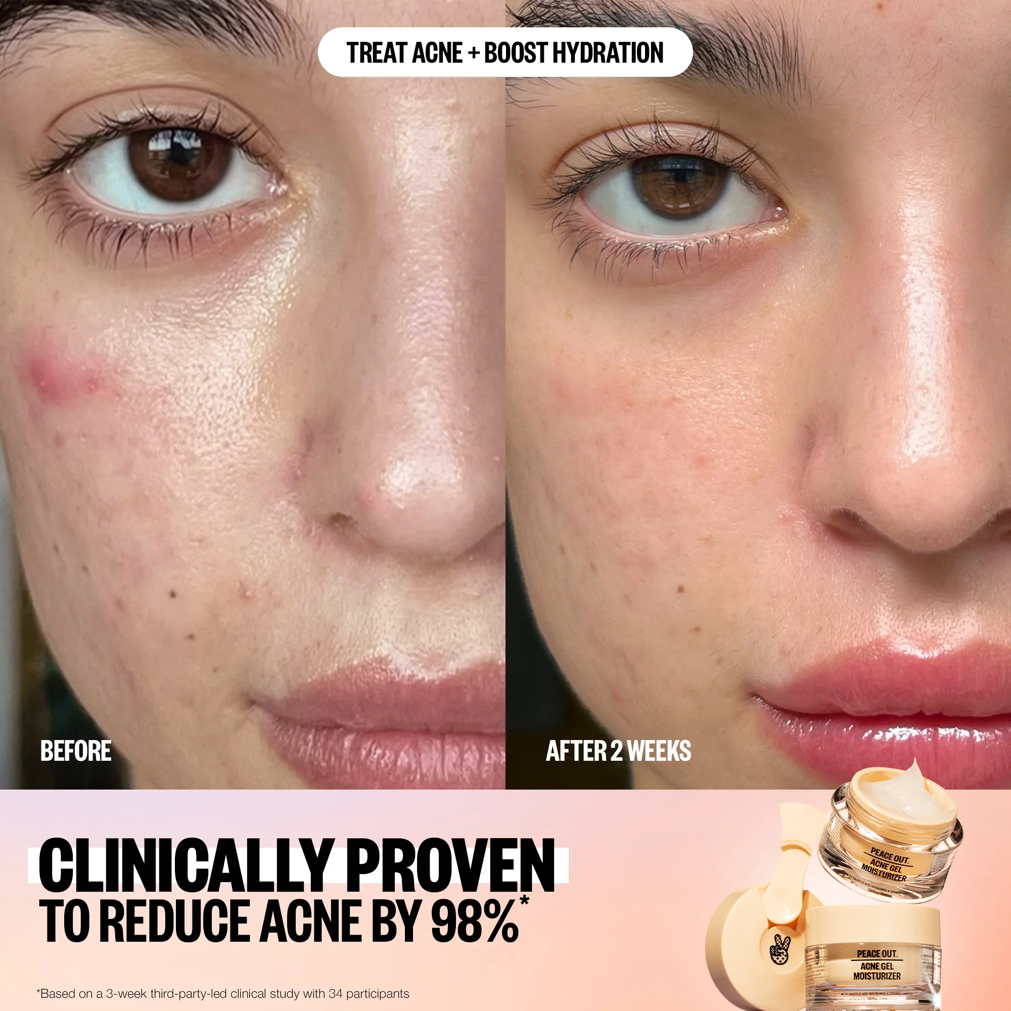 Acne Gel Moisturizer - Image 4