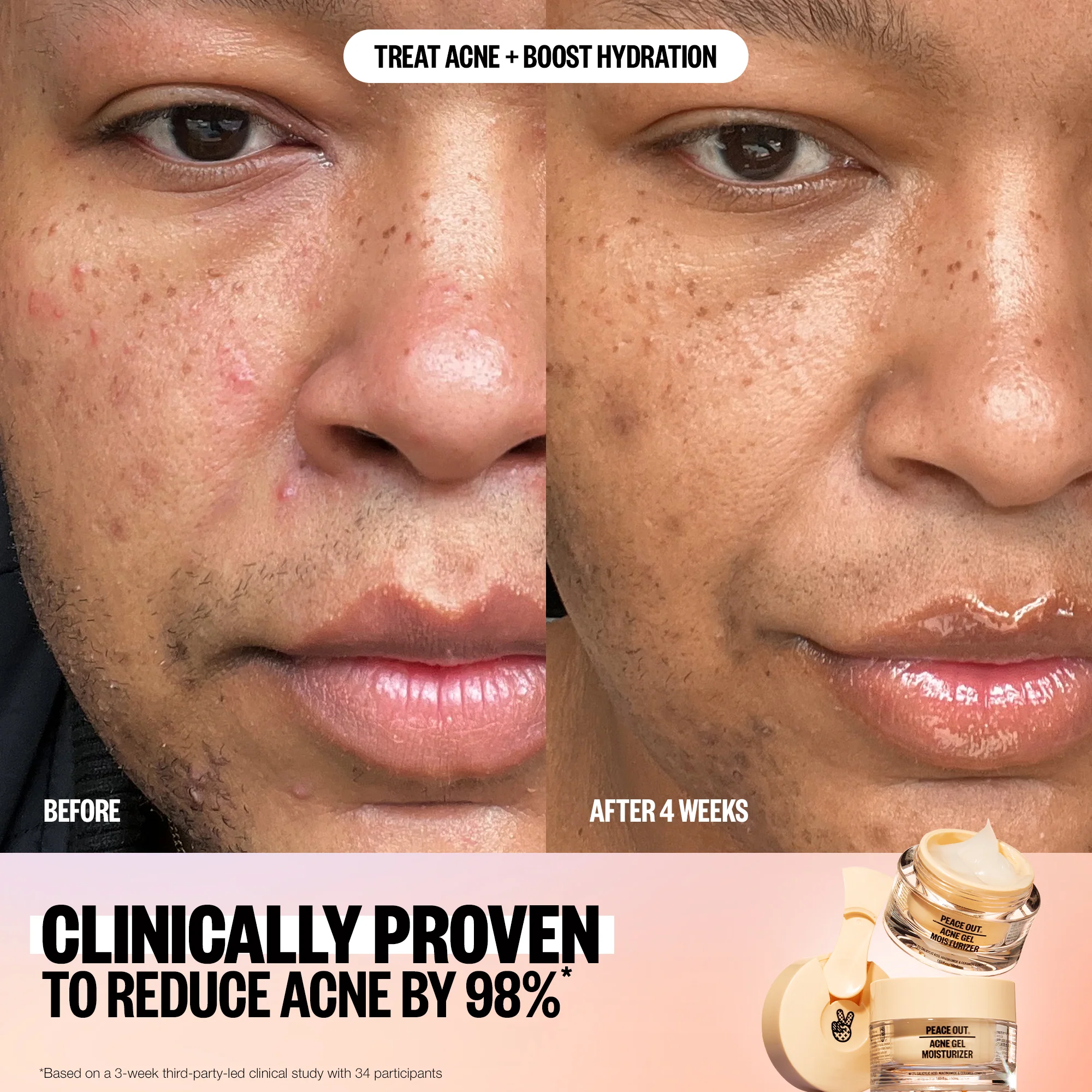 Acne Gel Moisturizer - Image 5