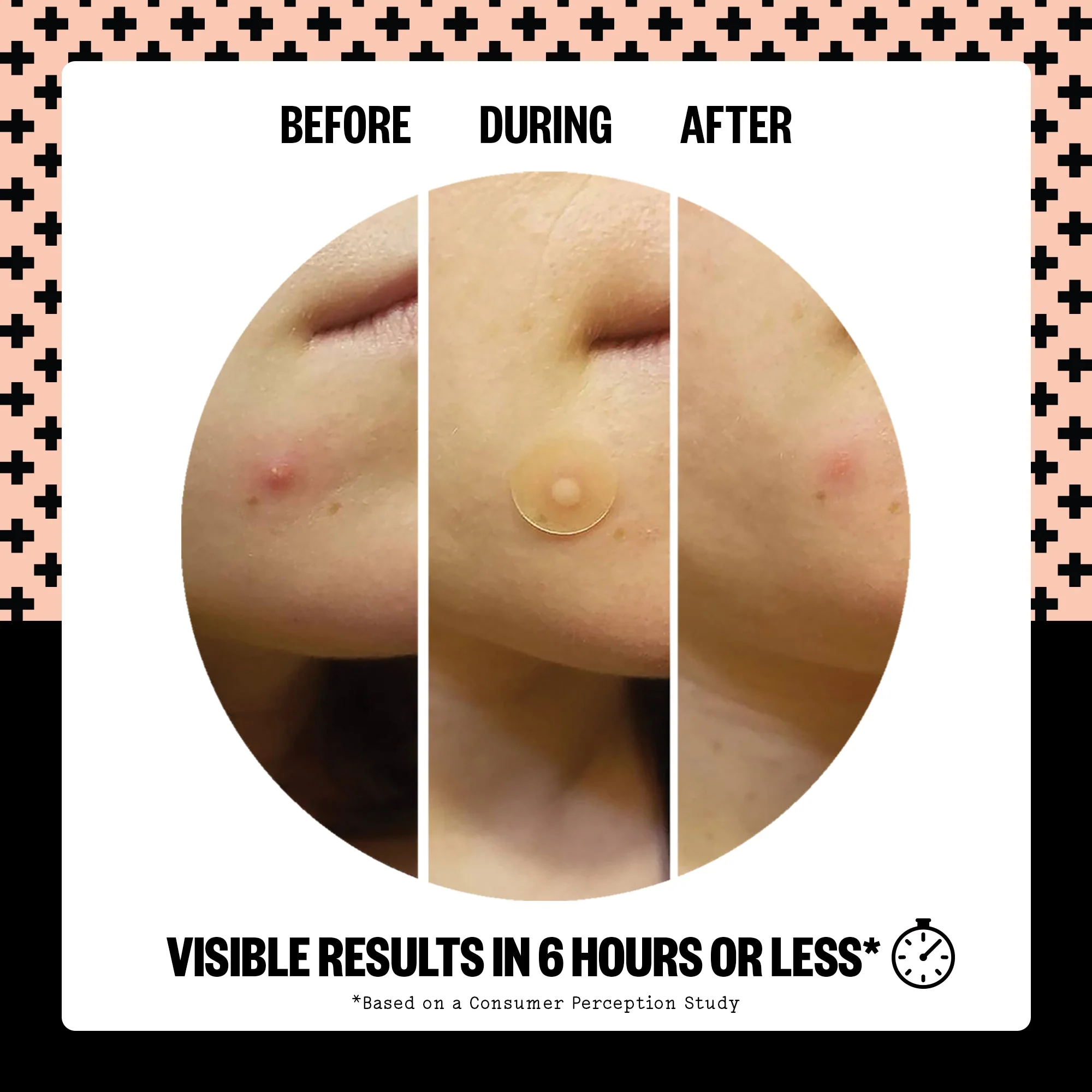 Acne Healing Dots (CAN) - Image 5