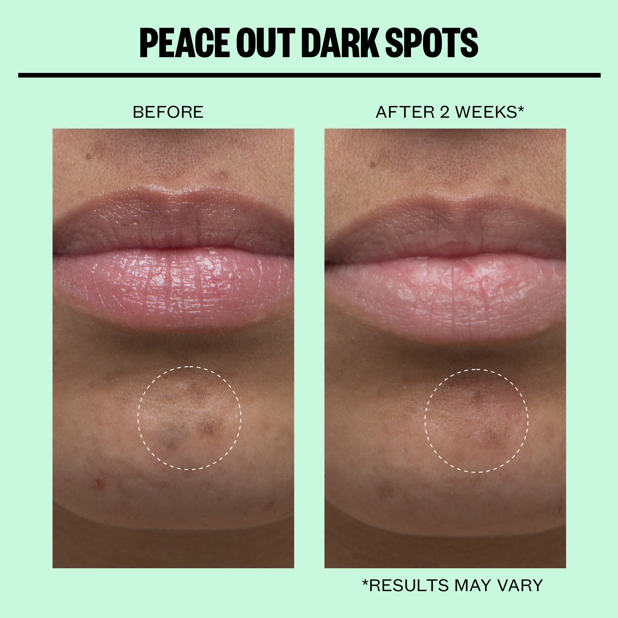 Dark Spots Microneedling Dots (CAN) - Image 3