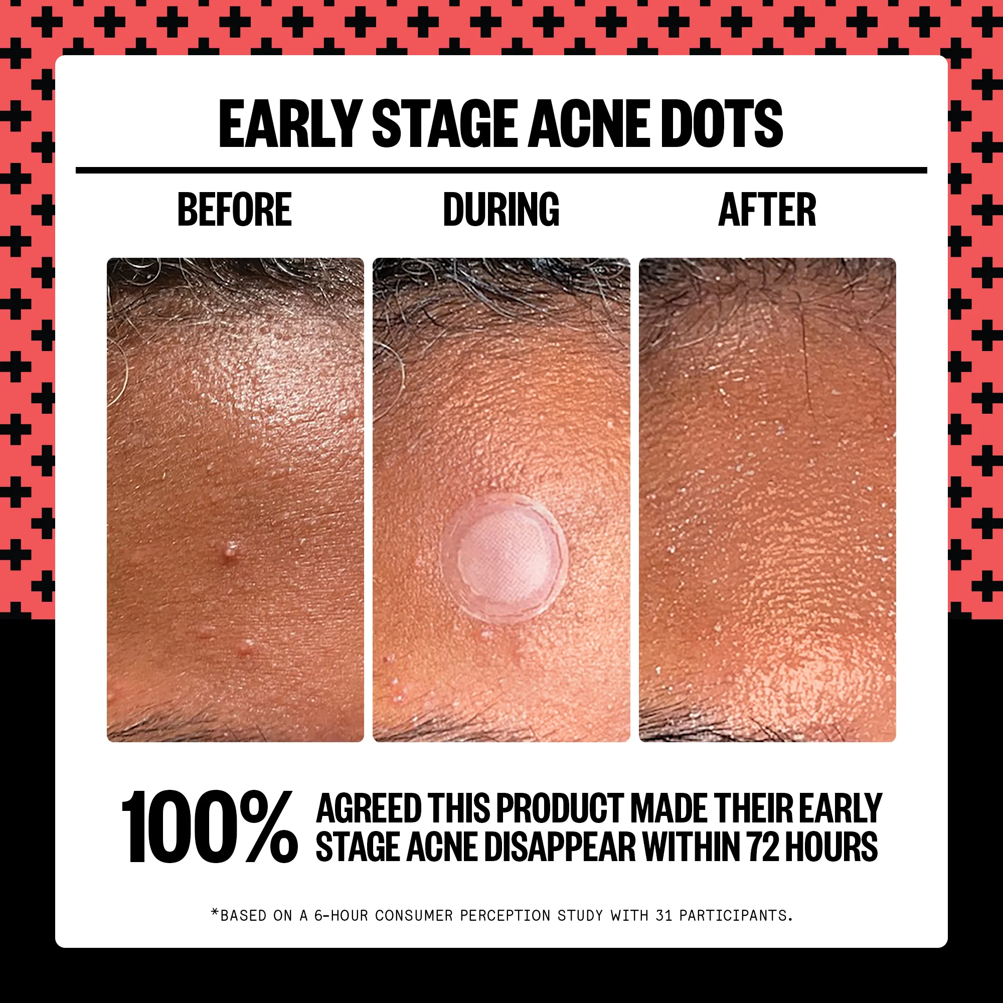 Early Stage Acne Dots - Image 3