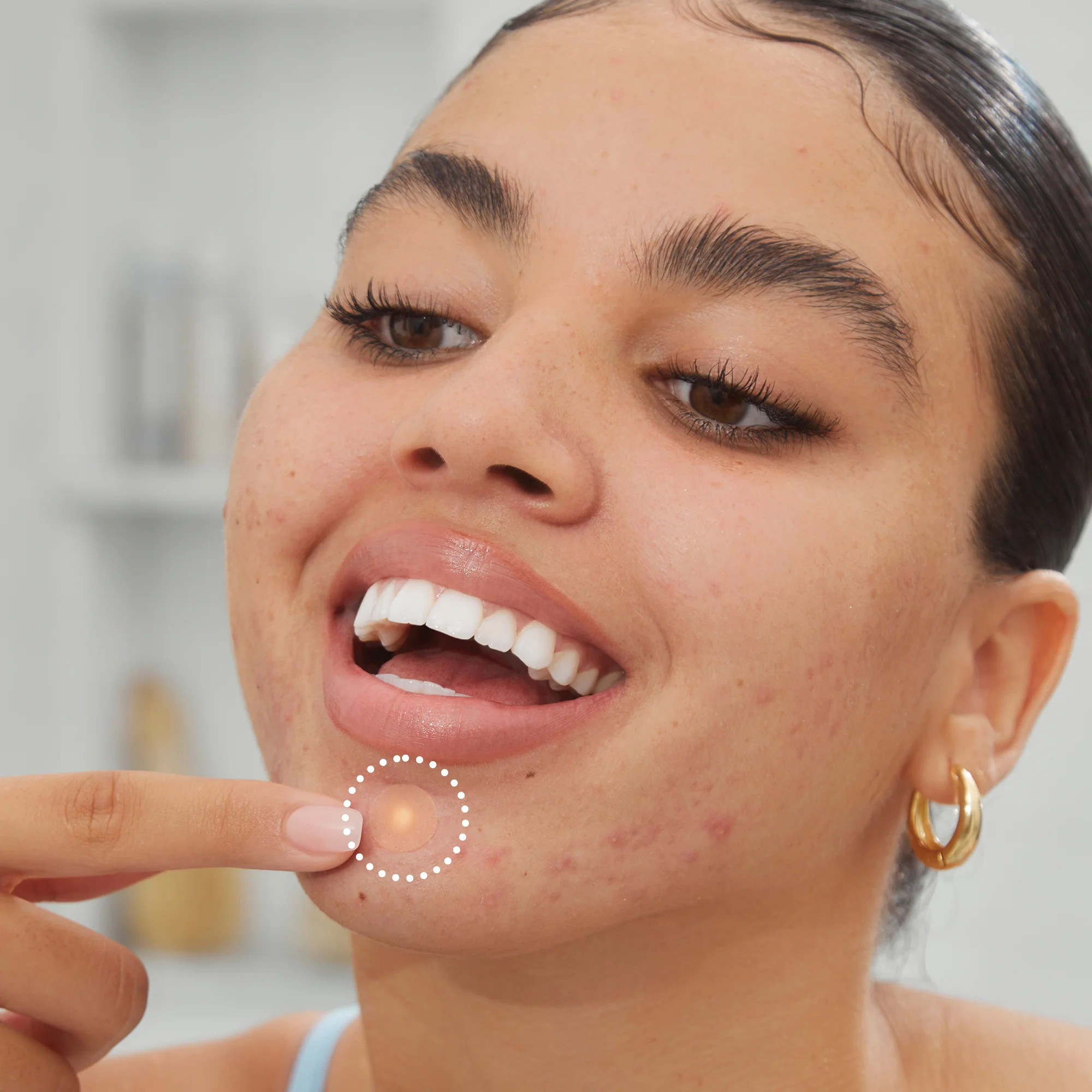 Acne Healing Dots - Image 10