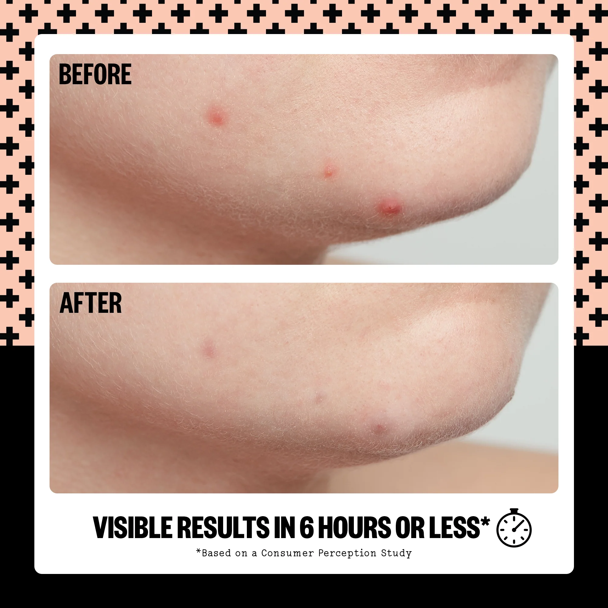 Acne Healing Dots - Image 6
