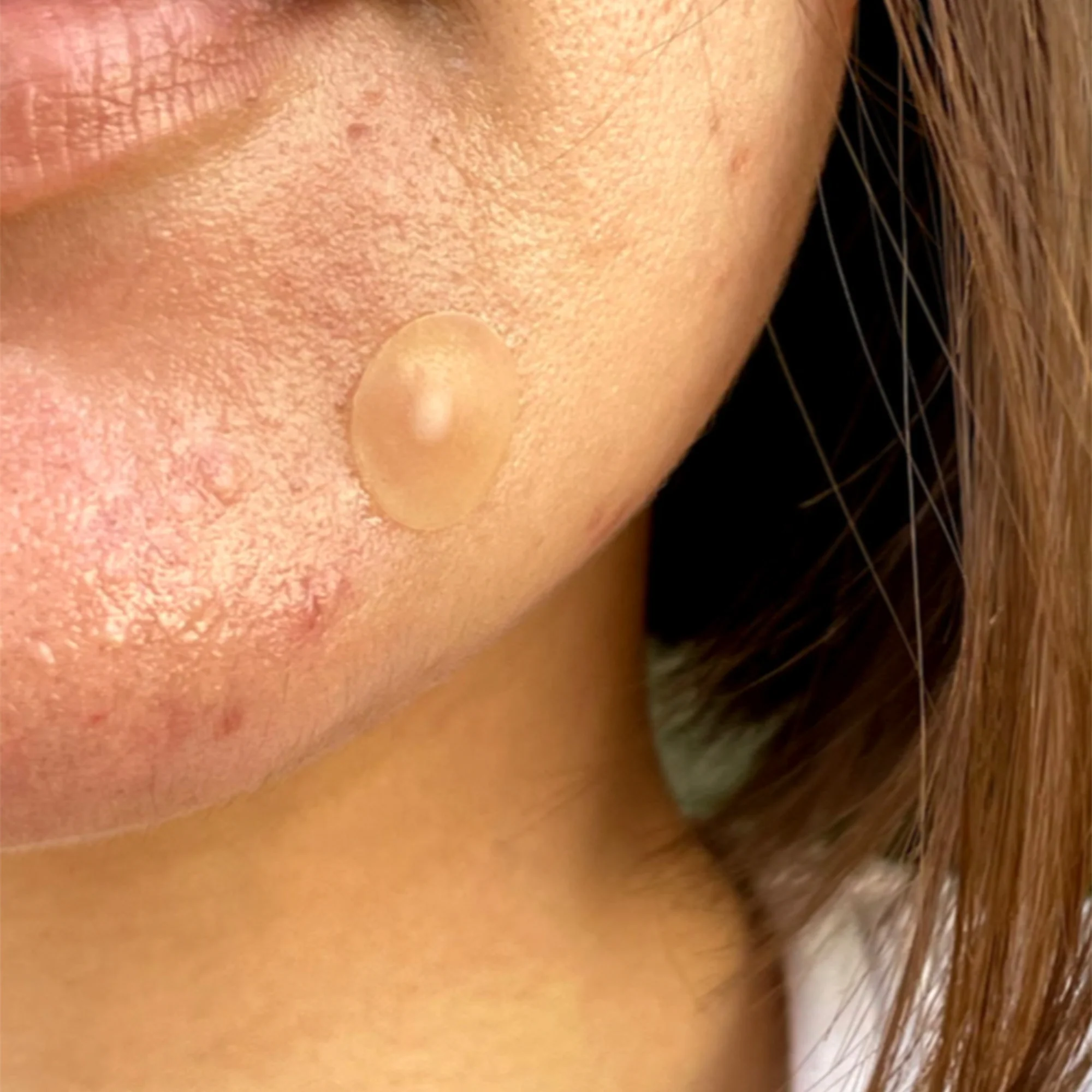 Acne Healing Dots Jumbo - Image 3