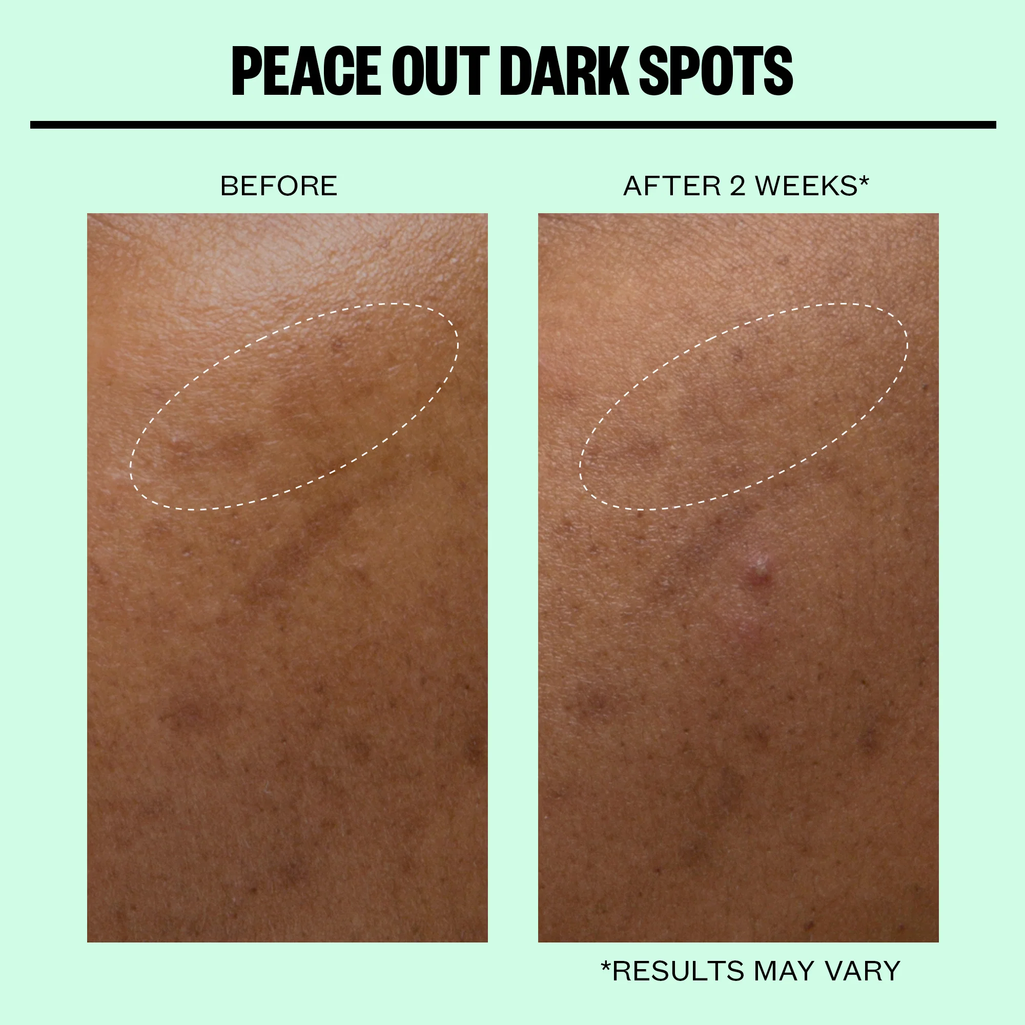 Dark Spots Microneedling Dots - Image 5