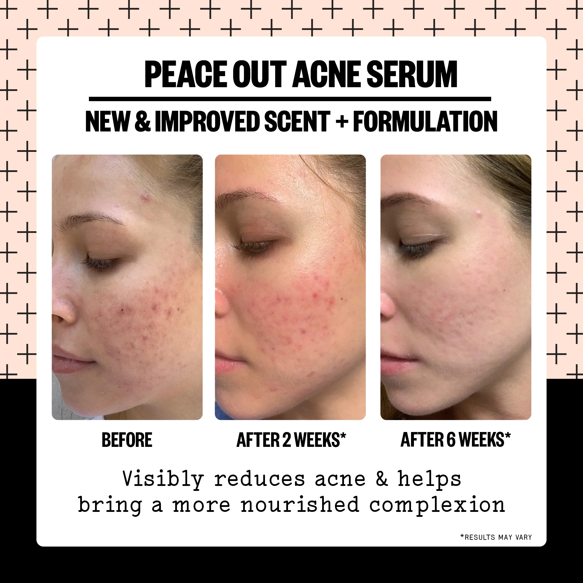 Acne Serum - Image 3