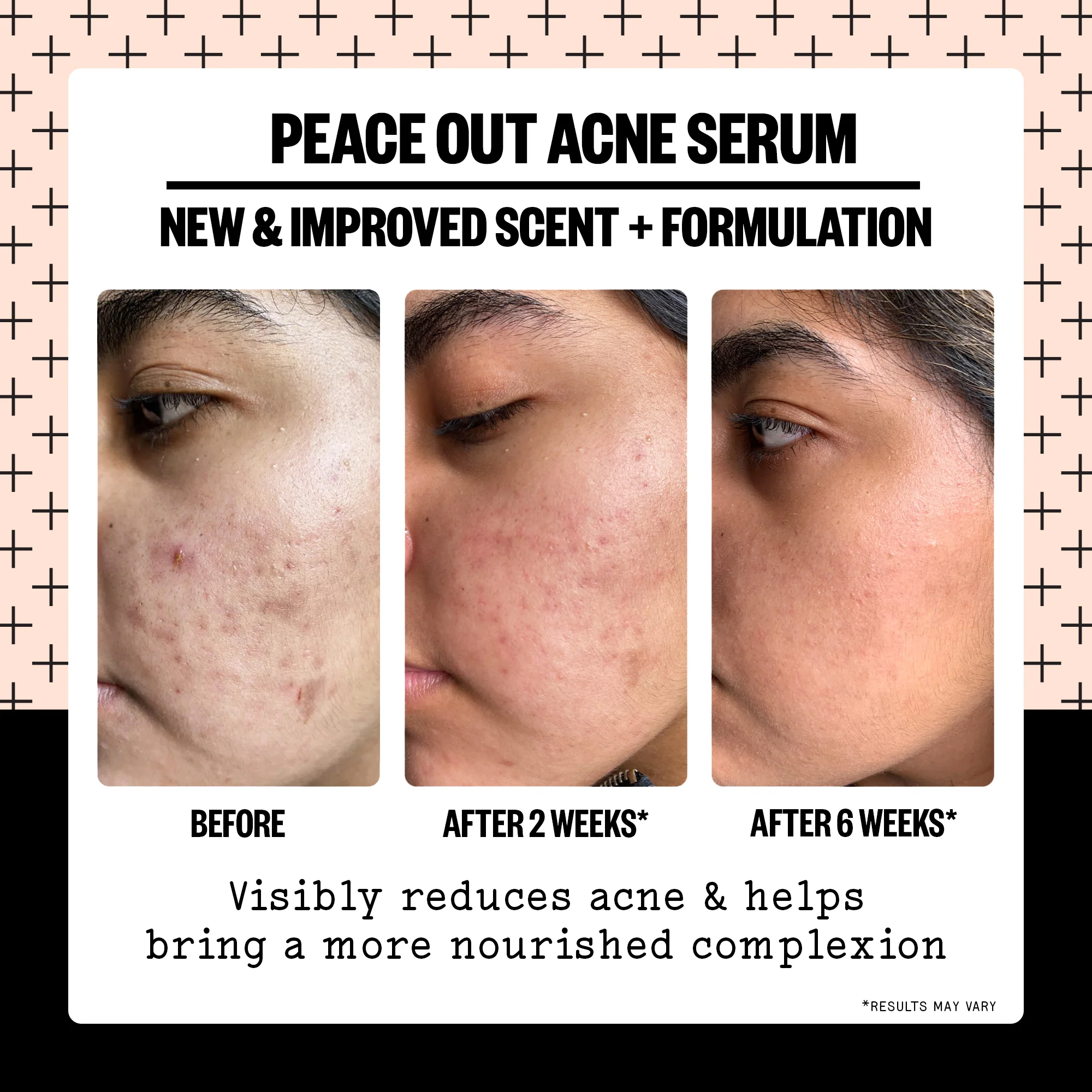Acne Serum - Image 5