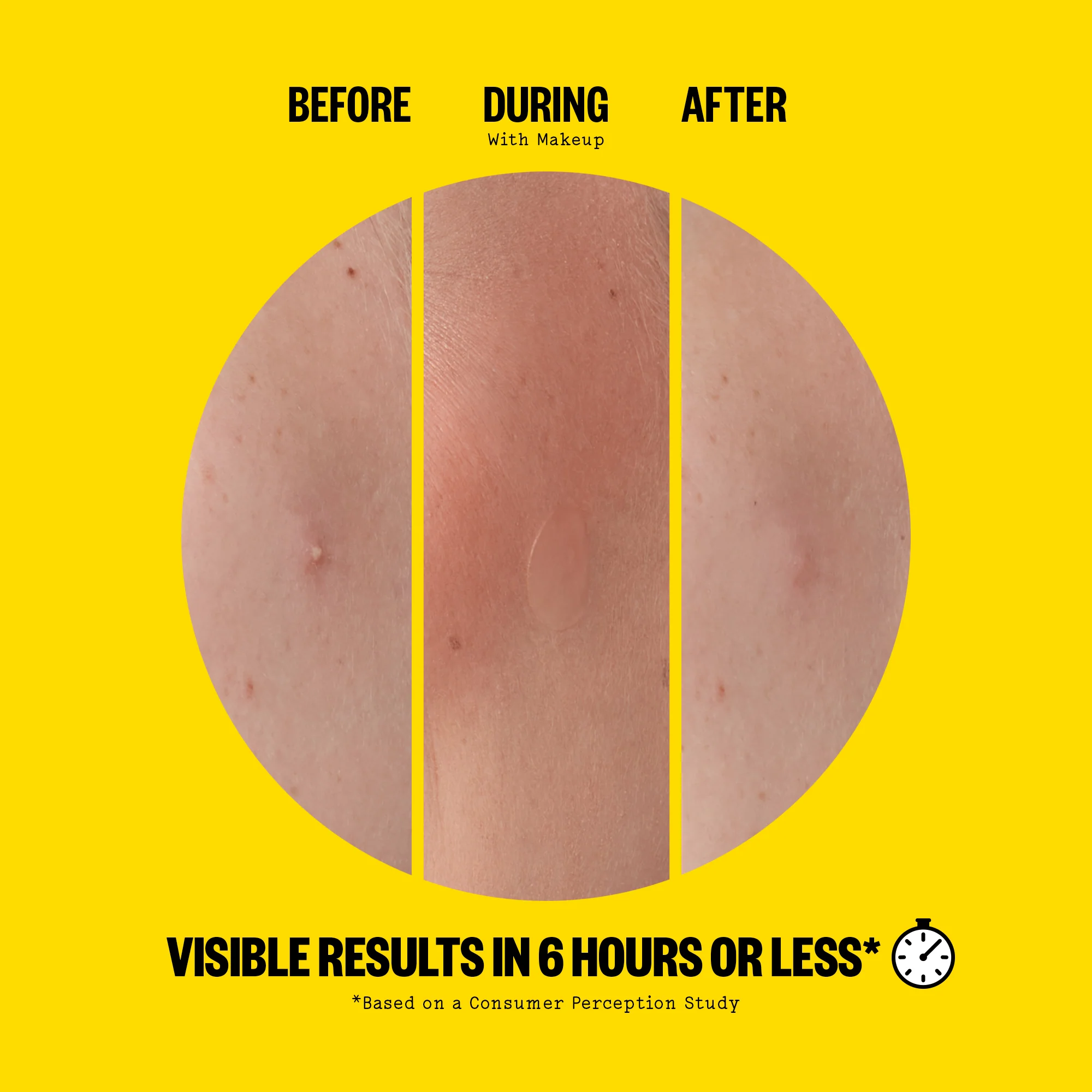 Acne Day Dots - Image 5