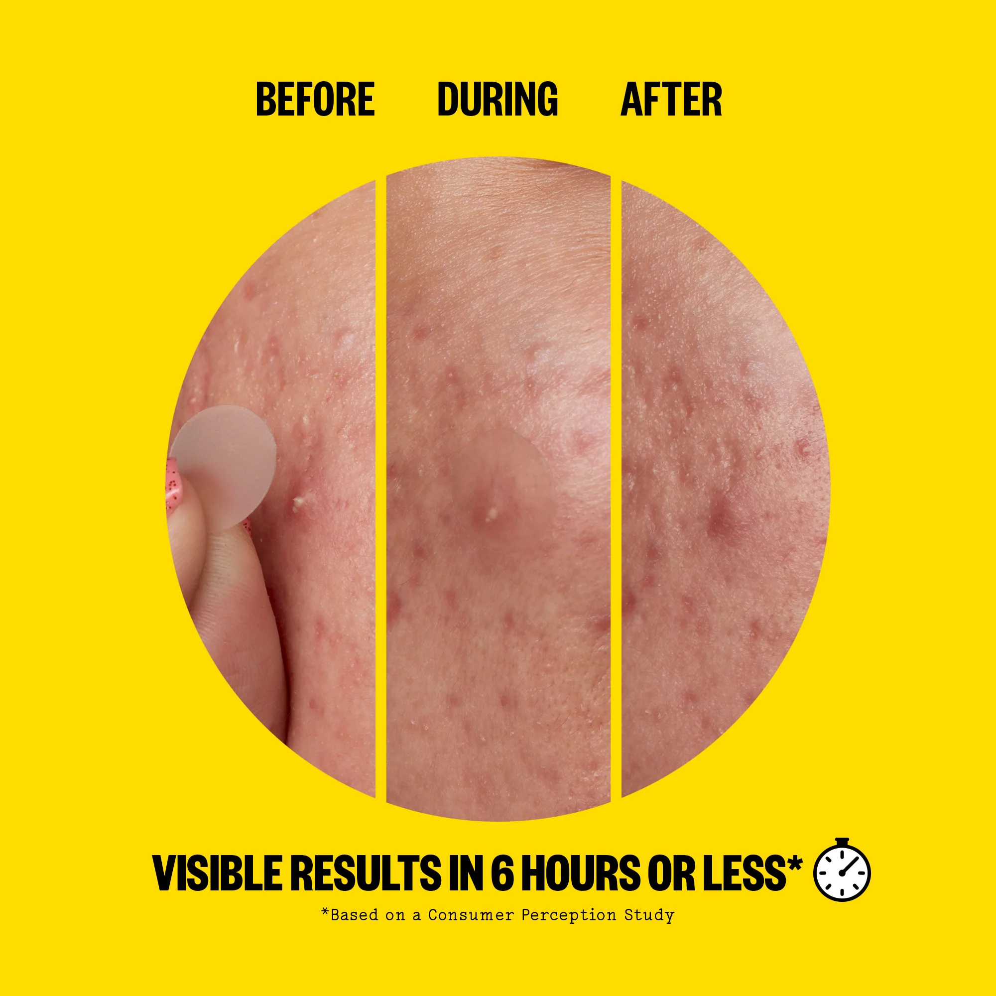 Acne Day Dots - Jumbo - Image 3